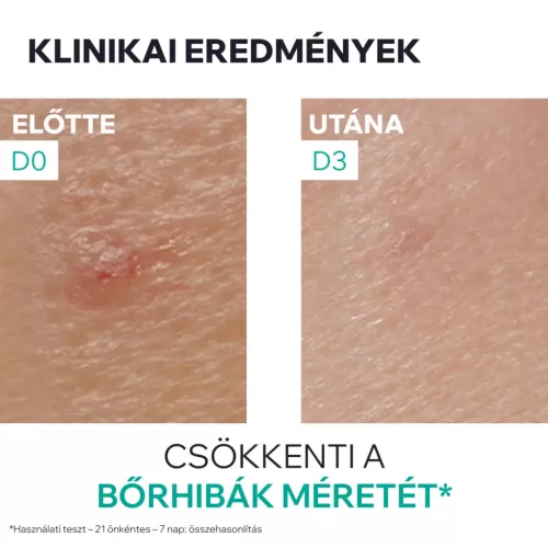 URIAGE Hyséac SOS paszta pattanásokra (15g)