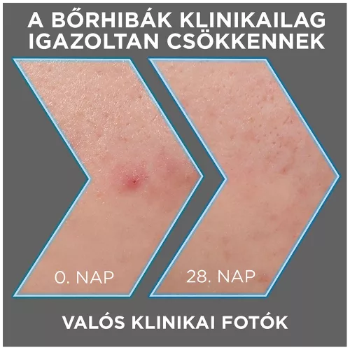 GARNIER Pure Active Charcoal szérum AHA + BHA + aktív szén (30ml)