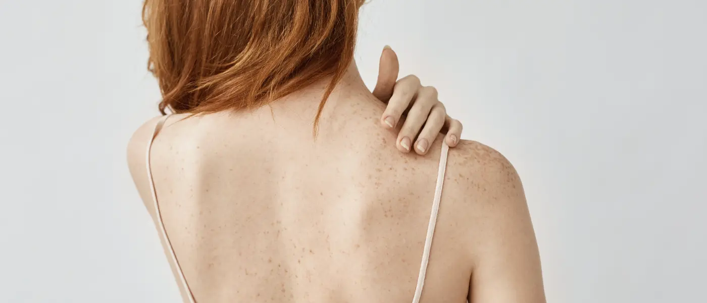 Mi a teendő, ha nem az arcon vannak pattanások? 